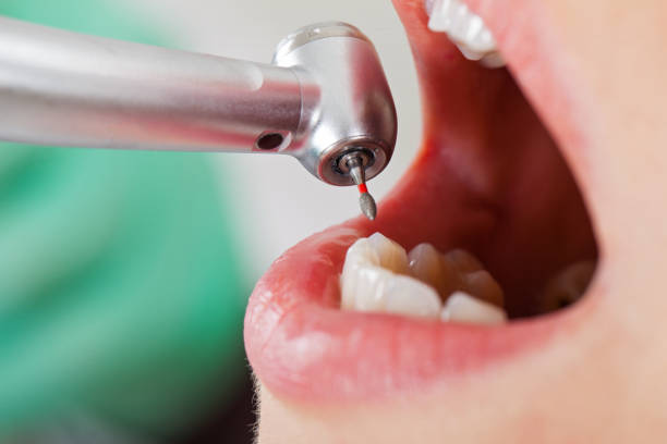 Best Emergency Root Canal Treatment in Harriman, NY